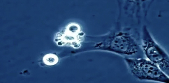Cáncer de células dendríticas 