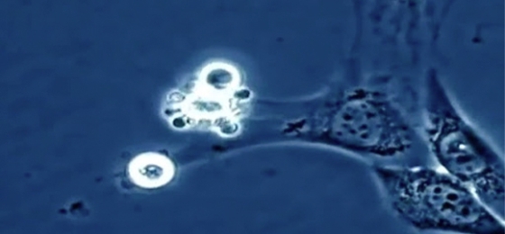 Cáncer de células dendríticas 
